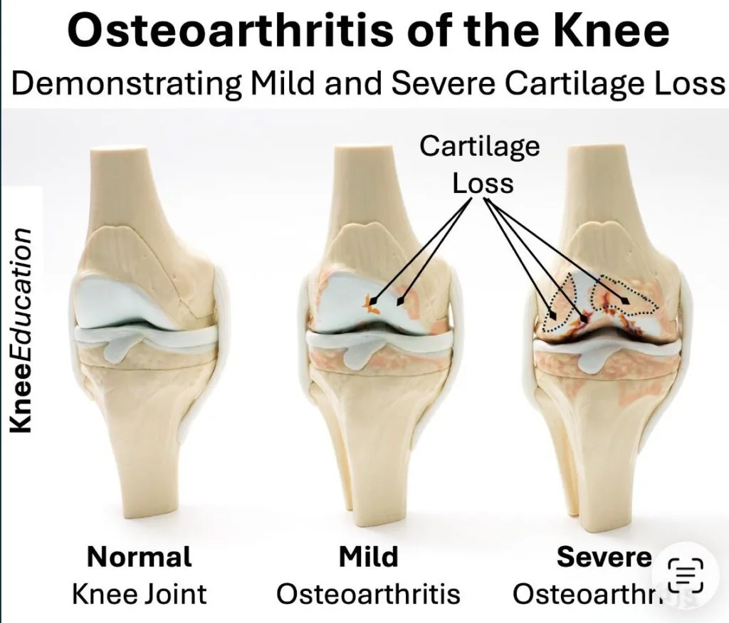 Cartilage regrowth illustration