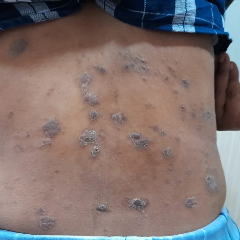 Psoriasis treatment overview