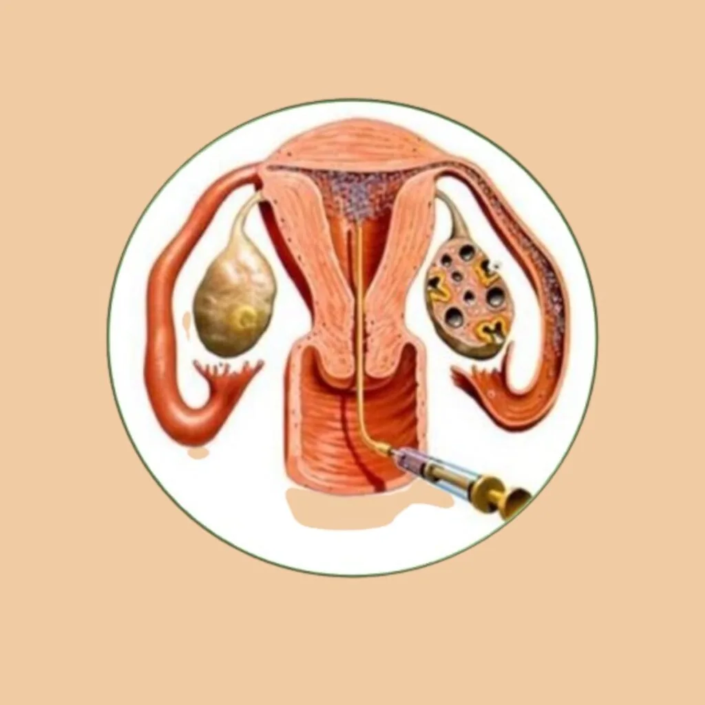 Uttara Basti therapy