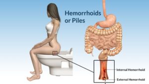 Hemorrhoids-Treatment-in-Ayulife