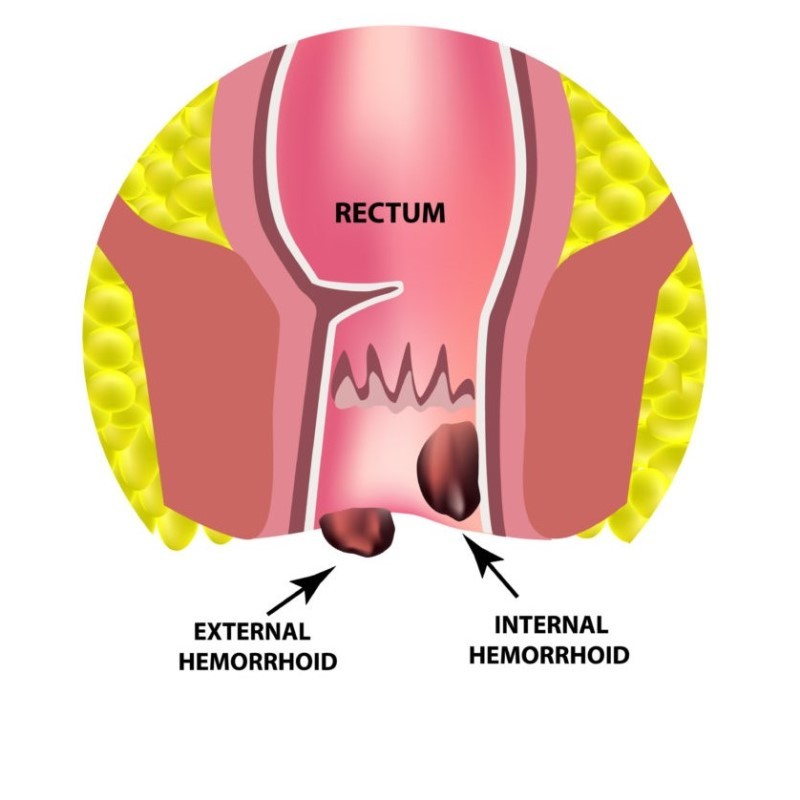 Piles-in-Ayurevda at Ayulife