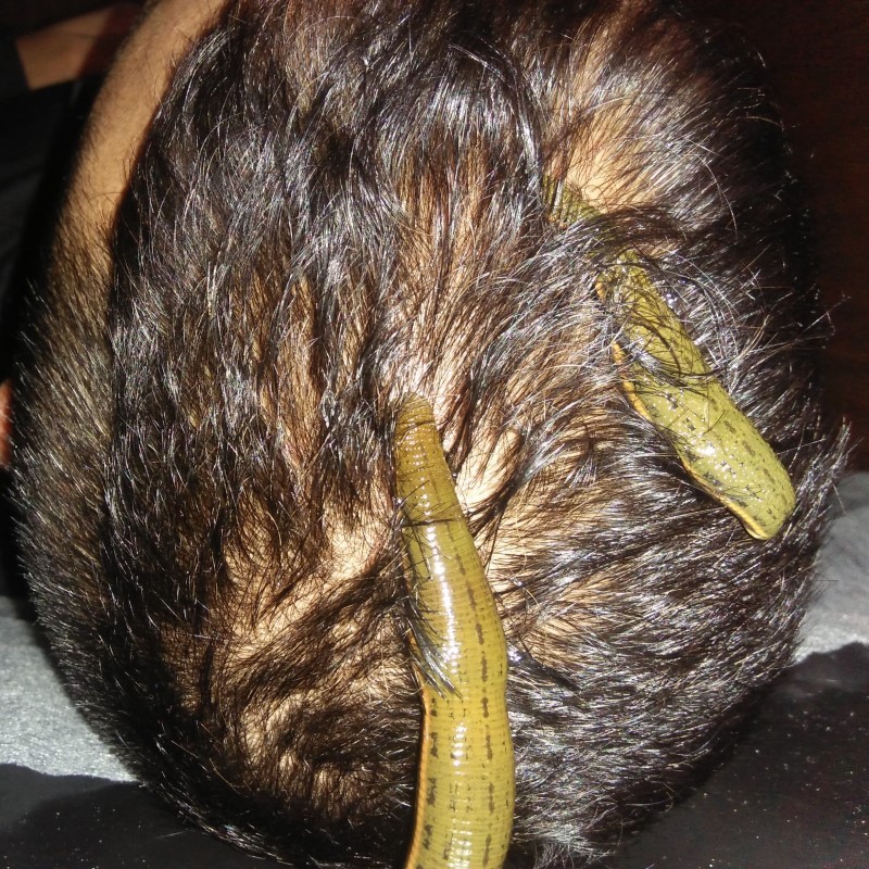 leech-therapy-for-hair-fall